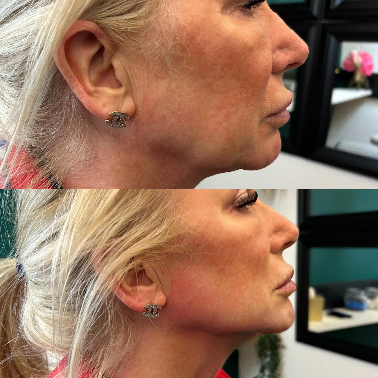  QT Injectables - Advanced Aesthetics-  Enquiries: qtinjectables1@hotmail.com  