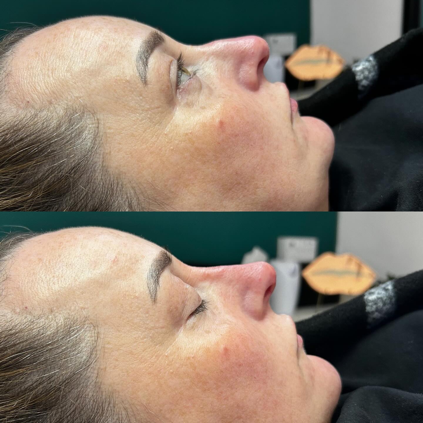  QT Injectables - Advanced Aesthetics-  Enquiries: qtinjectables1@hotmail.com  